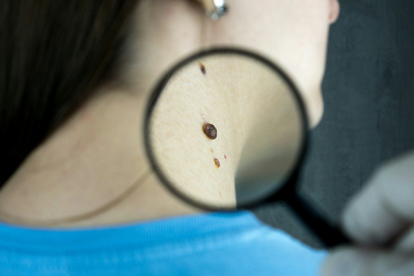 Skin being examined closely by a clinician