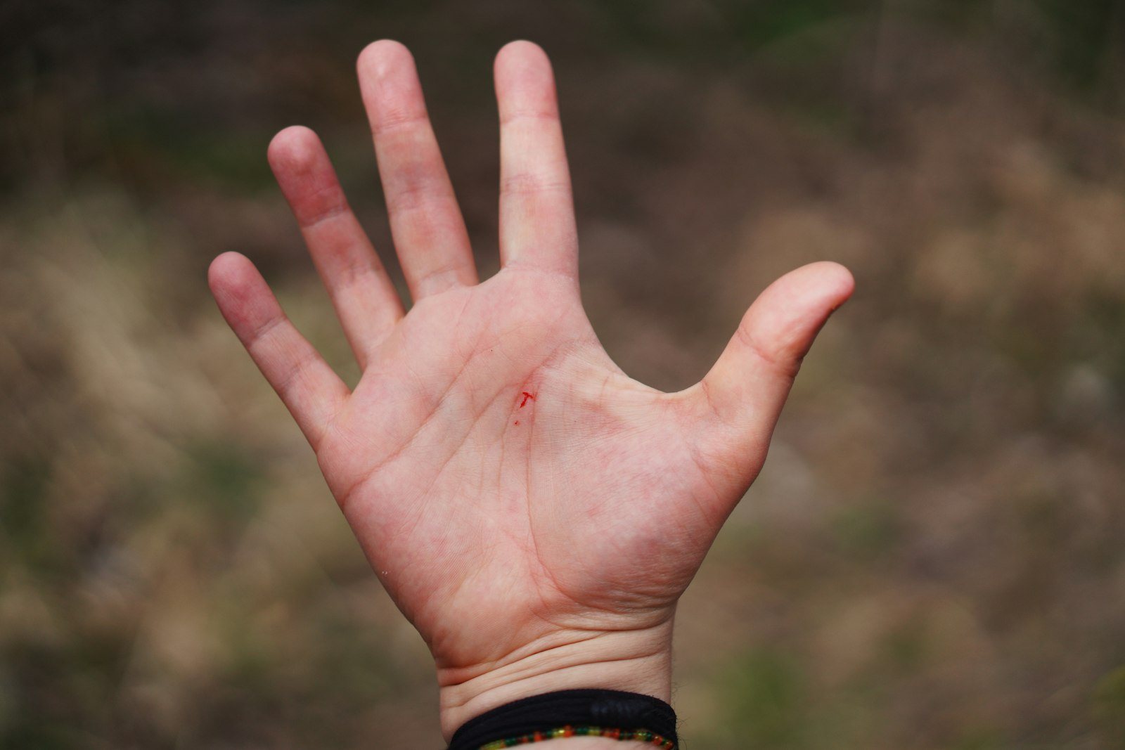 A small wound on a hand