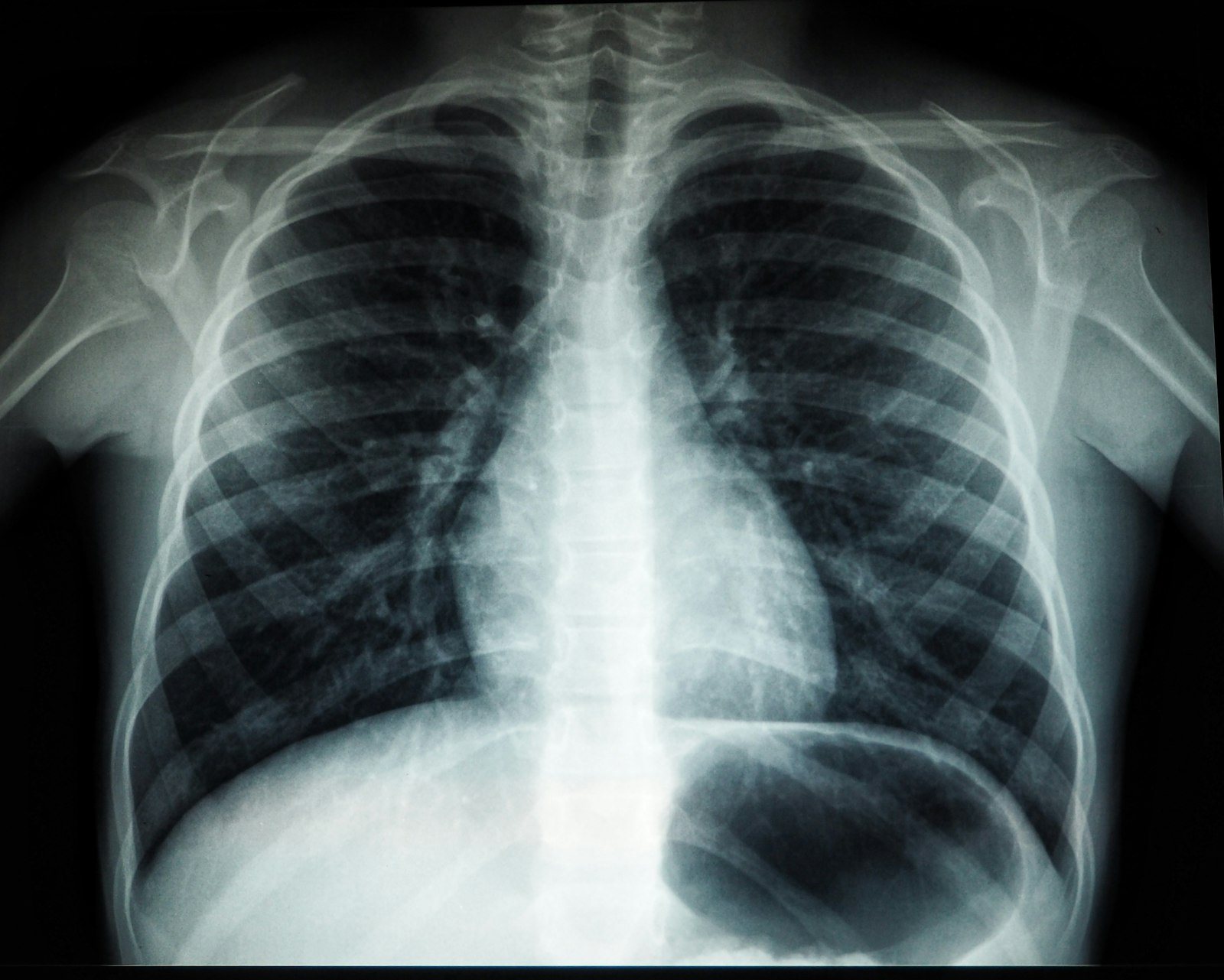 A chest X-ray